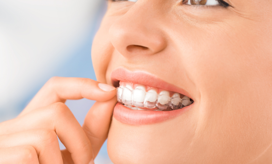 Invisalign: uma solução discreta e eficiente para a ortodontia