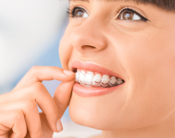 Invisalign: uma solução discreta e eficiente para a ortodontia
