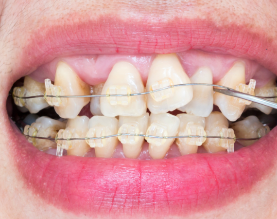 A mecânica ortodôntica com exodontia: quando e como utilizar