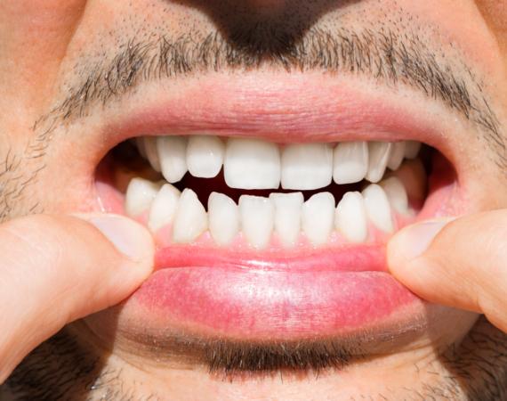 O maior erro da ortodontia dos últimos anos: falta de atenção à estabilidade do tratamento