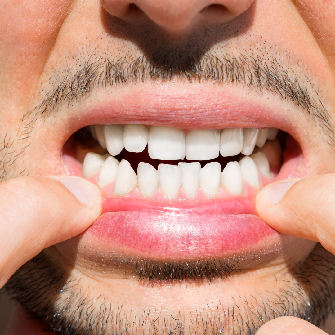 O maior erro da ortodontia dos últimos anos: falta de atenção à estabilidade do tratamento