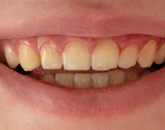 Bruxismo e Ortodontia: O que há de mais atual