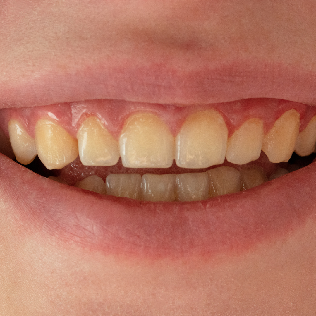 Bruxismo e Ortodontia: O que há de mais atual